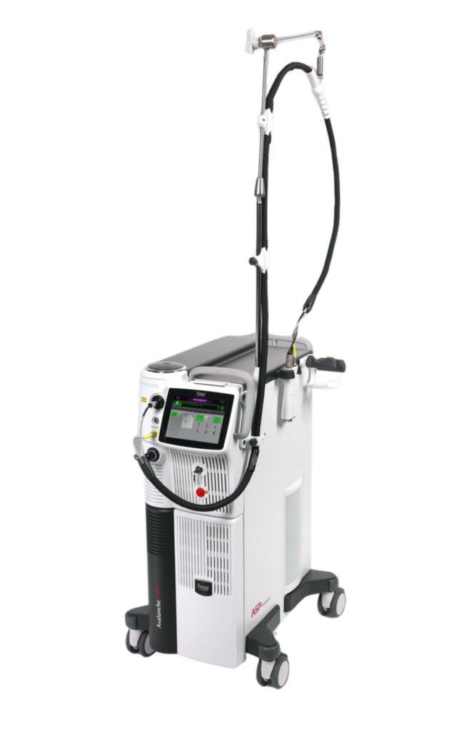 épilation laser
